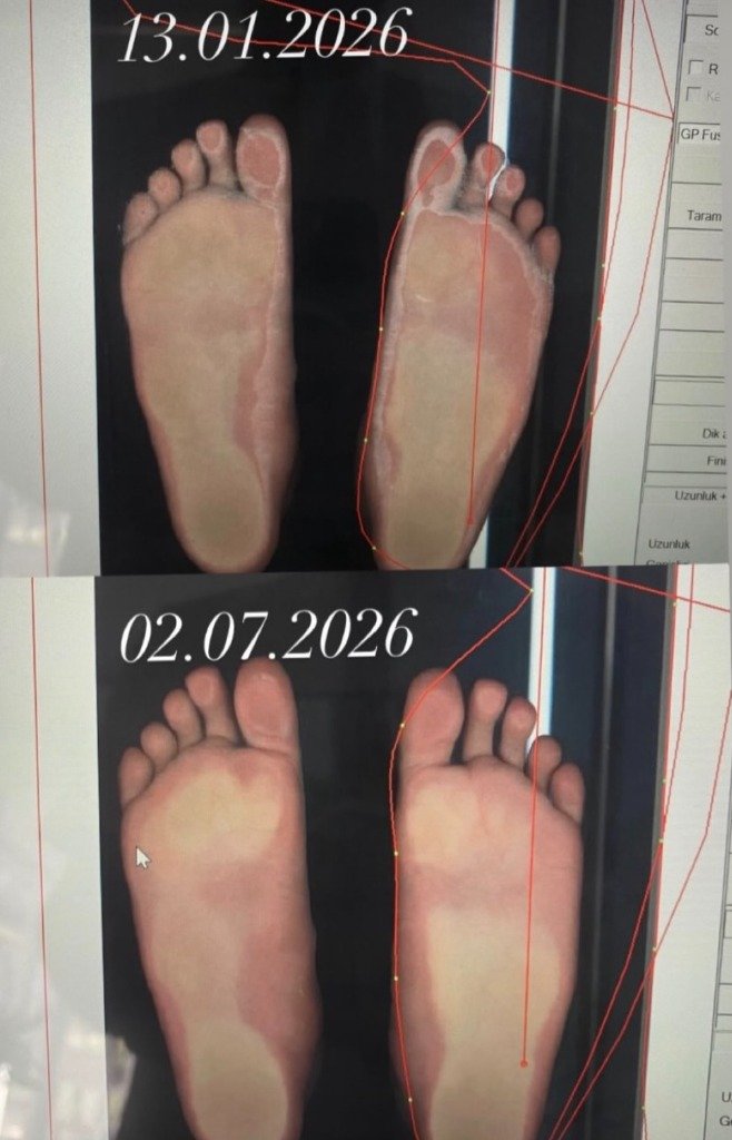 Comfortia Beylikdüzü Mağazasında 3D Lazer Ayak Basış Analizi